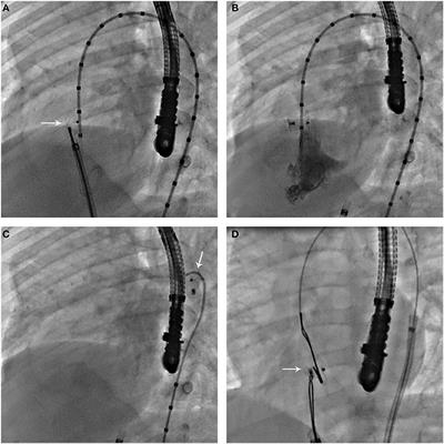 Frontiers | Device Closure of Perimembranous Ventricular Septal Defect